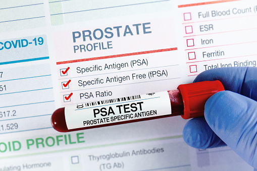 Prostate Specific Antigen or PSA is produced by the prostate gland and it is a main component of the seminal fluid. It is a reliable marker for the diagnosis of prostate cancer.