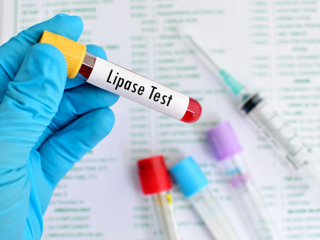 Lipase is an enzyme secreted in the pancreas. It plays an important role in the break-down, transport and processing of food lipids. Lipase is usually measured along with amylase for the diagnosis of acute pancreatitis. To a lesser extent, it is used for the diagnosis and follow up of other diseases such as cystic fibrosis, Crohn’s disease and celiac sprue.